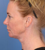 Face Lift/ Mini Lift/ Neck Lift