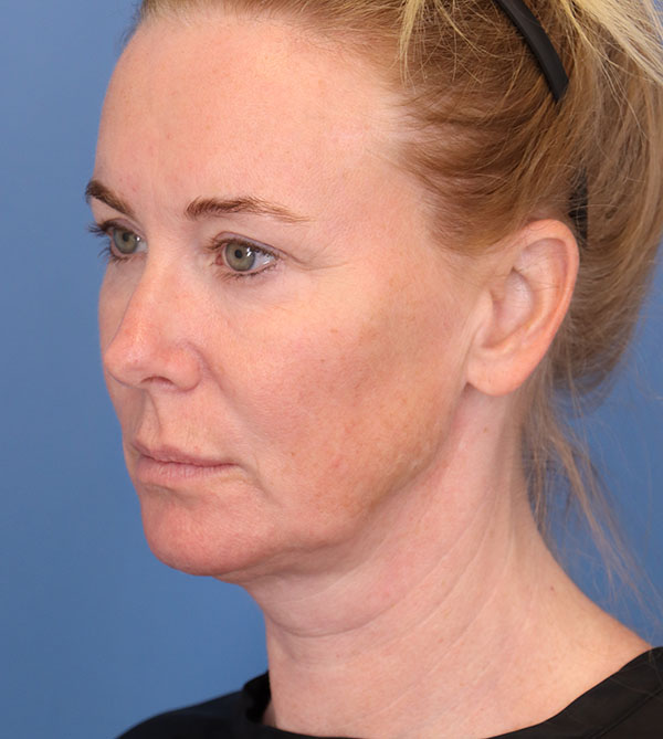 Face Lift/ Mini Lift/ Neck Lift