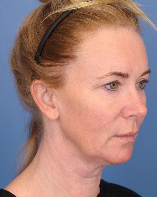 Facial Fat Transfer