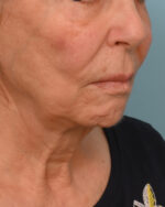 Face Lift/ Mini Lift/ Neck Lift