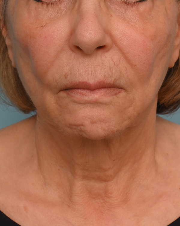 Facial Fat Transfer