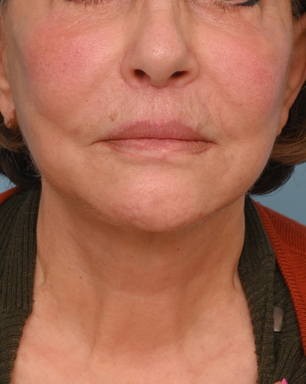 Face Lift/ Mini Lift/ Neck Lift