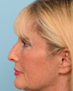 Rhinoplasty