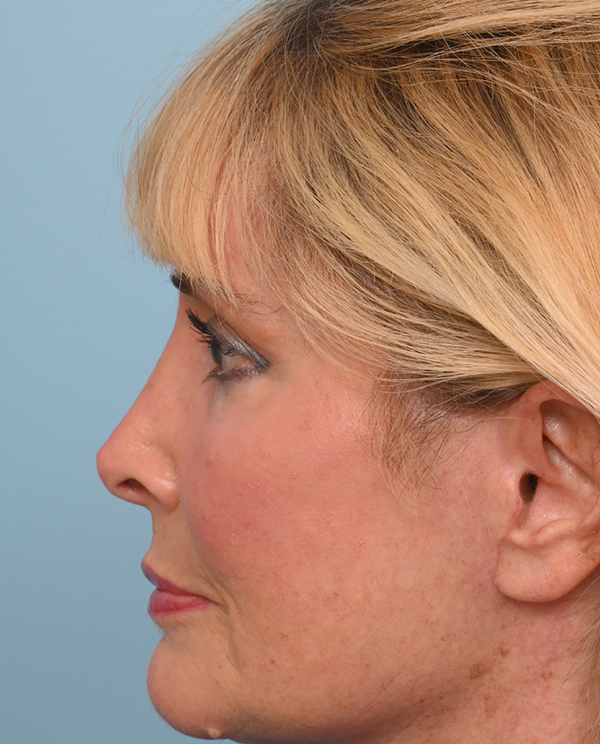 Rhinoplasty