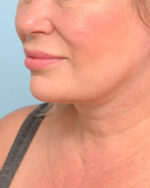 Face Lift/ Mini Lift/ Neck Lift