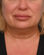 Face Lift/ Mini Lift/ Neck Lift