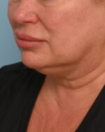 Facial Fat Transfer