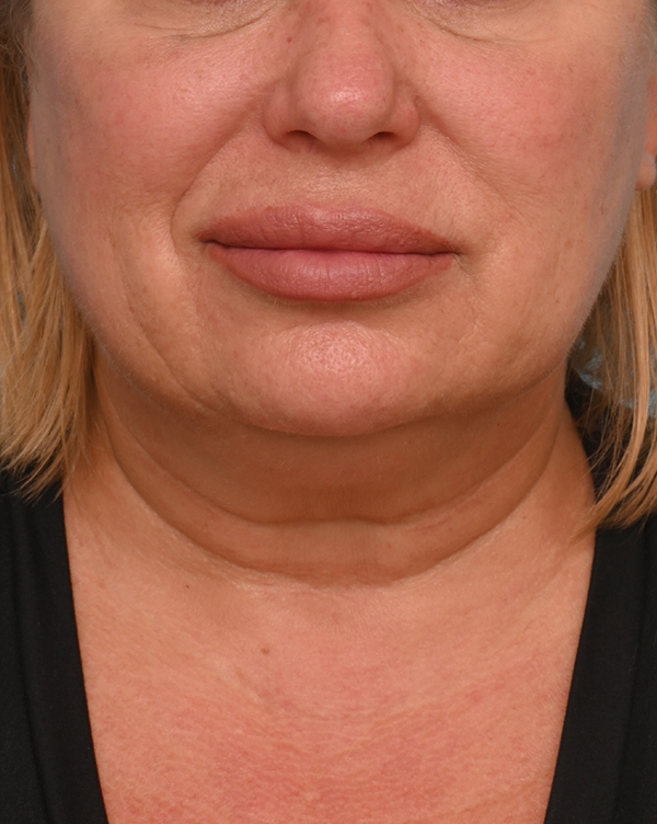 Facial Fat Transfer