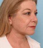 Face Lift/ Mini Lift/ Neck Lift