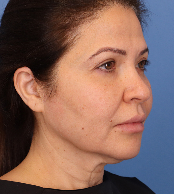 Face Lift/ Mini Lift/ Neck Lift